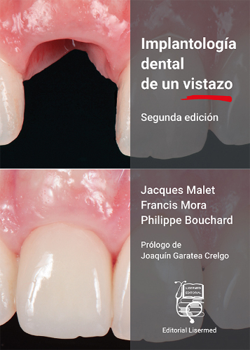 #Biblioinforma | Implantología dental de un vistazo
